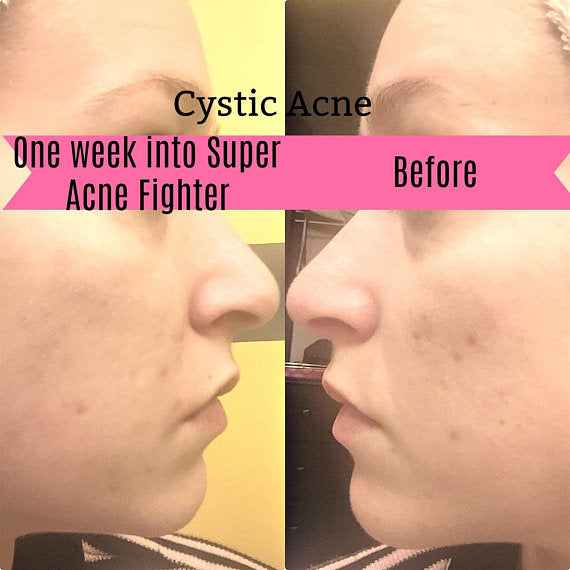 Super Acne Fighter Organic Acne Treatment for Clear Skin